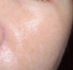 other cheek after using EverClear VC Vitamin C Serum 20% for one month