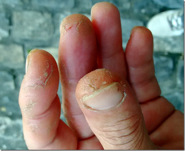 psoriase-palmar