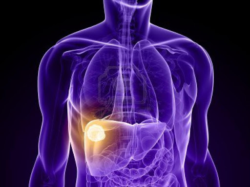 Liver cancer. File photo