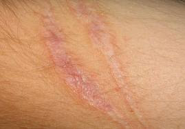 La Cure, Scars on face and body. www.brendasjordan.com