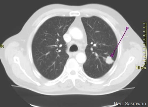 Hasil scan sinar X menunjukkan kanker paru-paru (warna putih)