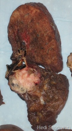 Paru-paru perokok yang sudah terkena kanker (putih). Terlihat paru-paru menghitam akibat asap rokok