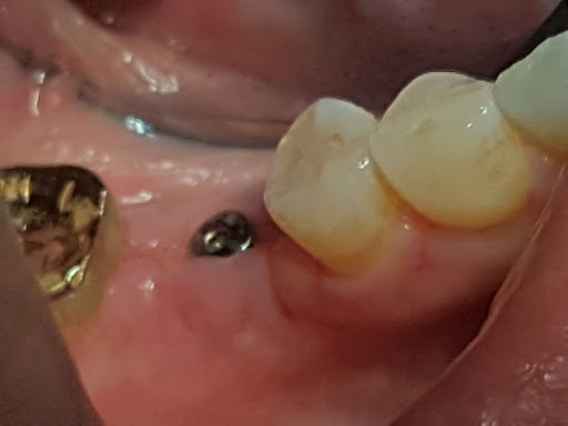 Implantes Y Periodoncia, Hidalgo 313, Zona Centro, 99600 Jalpa, Zac., México, Periodoncista de implantes dentales | ZAC