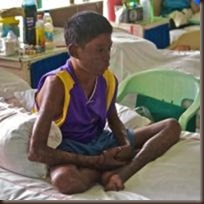 Filipino boy with leprosy by moyerphotos on flickr 200x200 75pc