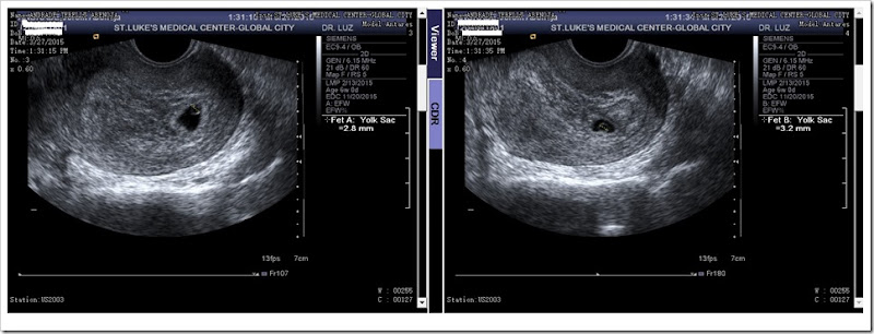 6th_week_ultrasound_twins