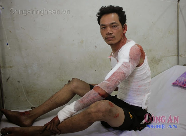 Những vết bỏng trên cơ thể anh  Dương Văn Quang do vụ nổ để lại