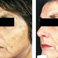 image of before  before laser pigmentation removal and after laser pigmentation removal show a dramatically clear skin free of pigmentation 