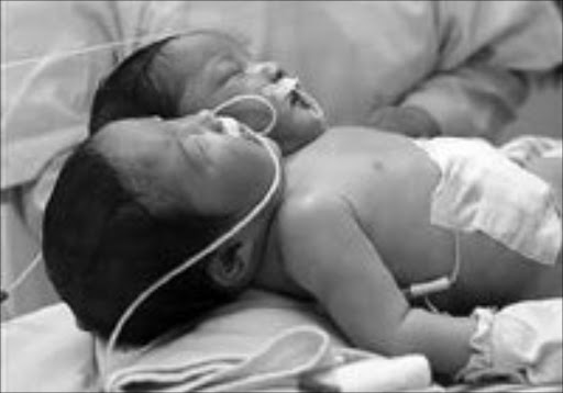 RARE BIRTH: These Ineisian twins was born in Jakarta last year. © Unknown.