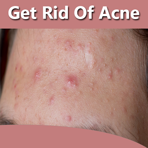 Download How To Get Rid of Acne Fast For PC Windows and Mac