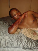 Thabang Moseetsi shows his wounds which he says are painful.