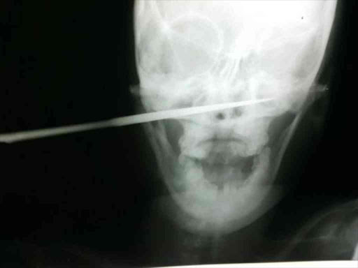 X-ray image showing the knife lodged in Fatuma Ibrahim's cheek