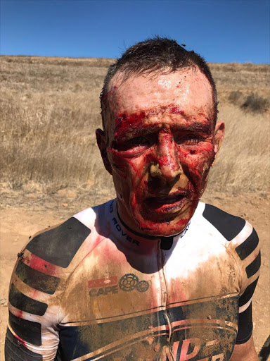 Joel Stransky after his fall during the Absa Cape Epic.