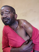 Frans Ndlovu was attacked by hyena at a Musina game
farm in November last year.