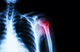 shoulder surgery melbourne, 