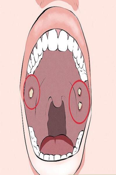 Android application Oral cancer screenshort