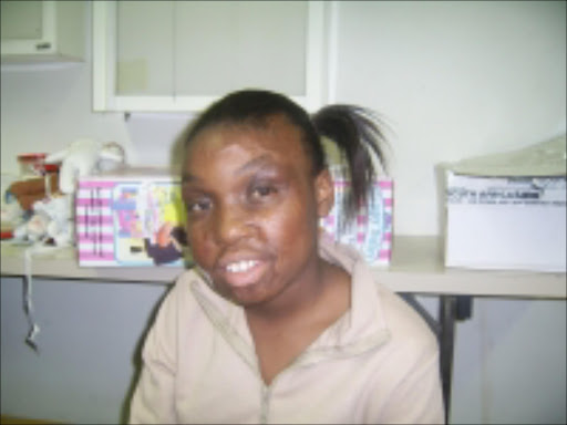 Petunia Maela, 13, of Primrose Hill is one of the children that are undergoing facial reconstruction surgery at the Johannesburg General Hospital. Pic. Tebogo Monama. 08/2007. © Sowetan.