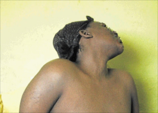 IN PAIN: The woman whose breasts grew as a result of the side effects of her ARVs. She is now receiving treatment at Charlotte Maxeke Hospital in Johannesburg. PHOTO: BUSISIWE MBATHA