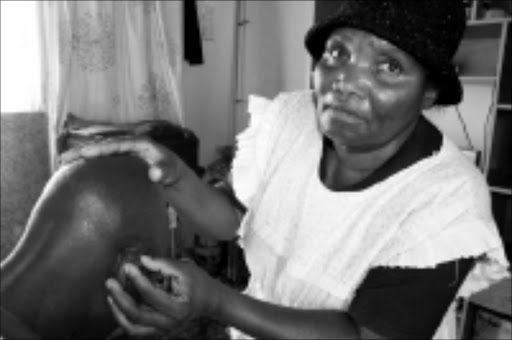 MISERABLE: Isaac Manave's mother, Eunice, shows the hole behind her son's ear that was said to have been left open after an operation in 1983 to remove a tumour. Pic. Thuli Dlamini. 08/09/08. © Sowetan.