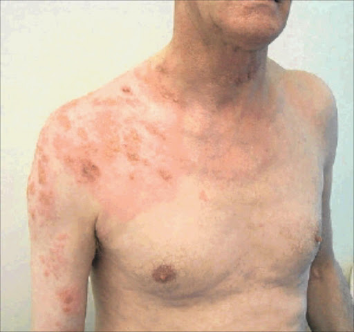 Meningococcal: Skin rashes may be a sign of meningitis.