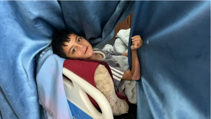 A boy receiving treatment at the European Hospital in Rafah