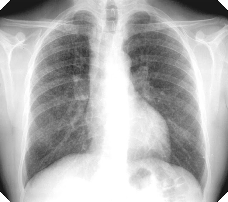 A chest X-ray of simple silicosis.