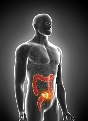 Colorectal cancer is spreading among black men too. /123RF