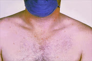 Rose spots on the chest of a patient with typhoid fever due to the bacterium Salmonella typhi. Symptoms of typhoid fever may include a sustained fever as high as 103° to 104° F (39° to 40° C), weakness, stomach pains, headache, loss of appetite. In some cases, patients have a rash of flat, rose-coloured spots.