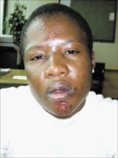 INJURED: Mpilo Thabede, 23, says she was called a drug-dealing foreigner. 03/05/09. Pic. McKeed Kotlolo. © Sowetan.
