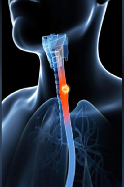 Android application Throat cancer screenshort