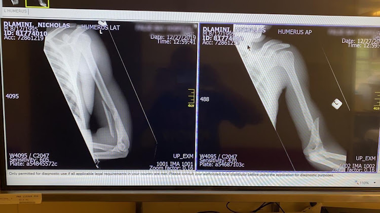 An x-ray showing the break