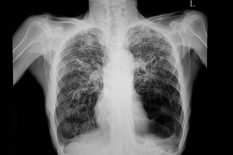 A South African study has found that despite being successfully treated for tuberculosis, teenagers who've had TB are unlikely to regain their lung function and are at risk of developing chronic lung disease much earlier in life. File photo.