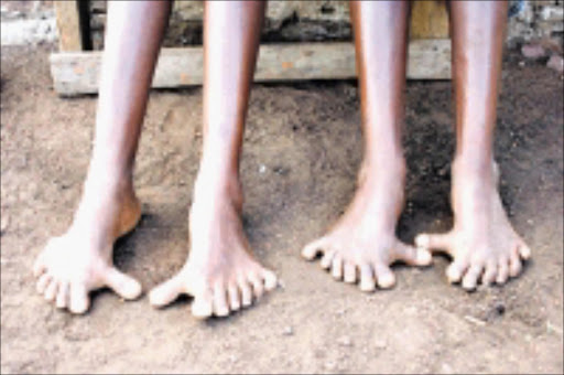 Twins Bongiwe and Bongekile Mthembu,15 sometimes they do not go to school because they don't have shoes because of their feet. Pictured with their mother Hlaleleni Mpontshana. PIC: THULI DLAMINI. CIRCA JUNE, 2009. © SOWETAN