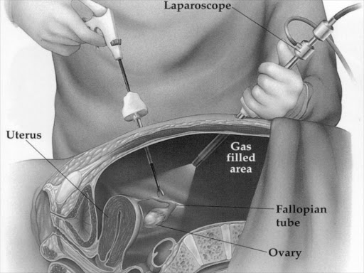 Laparoscopic surgery is among those administered during treatment of inflammations of reproductive organs. /FILE