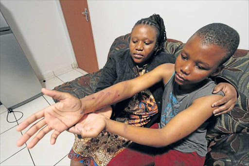LASHES: Busisiwe Mapapu and her son SIyavuya, 14, show some of the marks where he was sjambokked, allegedly by his principal at Cofimbvaba village school Picture: LULAMILE FENI