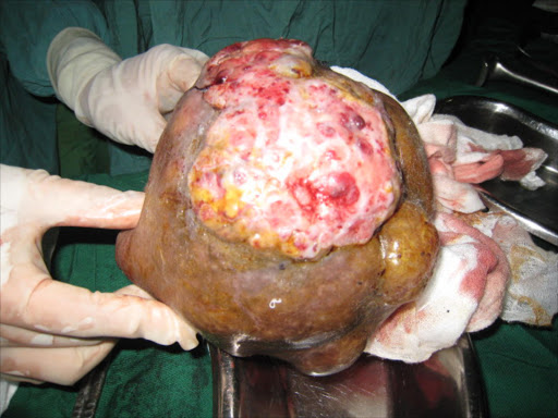 A massive tumour after its removal.