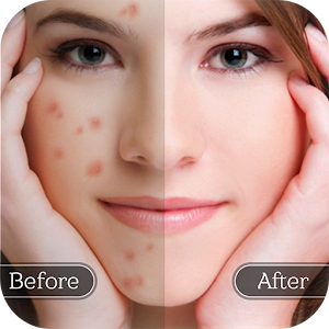 Download Face Blemish Remover For PC Windows and Mac