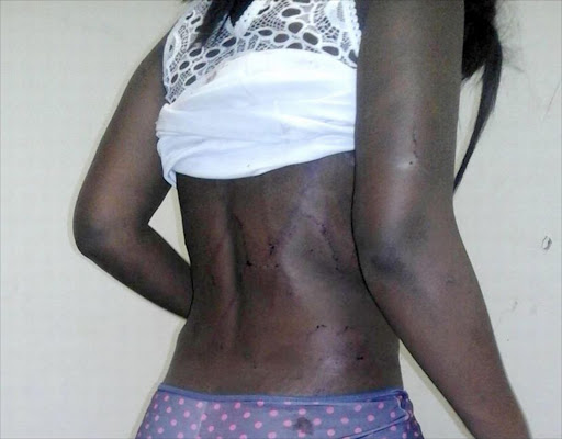 A Carletonville woman shows the scars she got from a local pastor who took turns raping and assaulting her and two other friends with a baton and a wire in the bedroom while his wife watched TV in the lounge on the night of April 3, 2016. The gun-toting pastor has since been arrested.