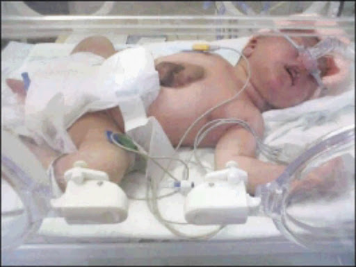 RARE CONDITION: Baby Ashleigh Louw was born with his heart outside the chest at Chris Hani-Baragwanath Hospital in Soweto. Pic:Siddique Davids/Gauteng Health and Social Development © Unknown