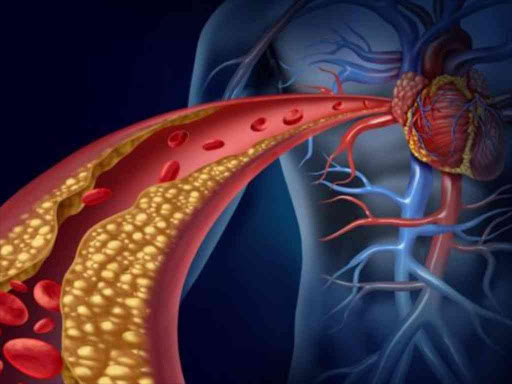 Blocked arteries impede blood flow. AGENCIES
