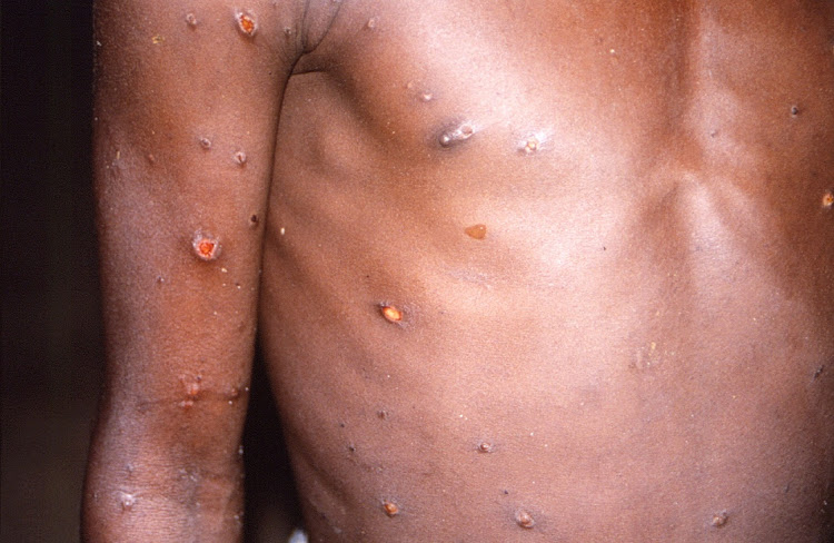 The arms and torso of a patient with skin lesions due to monkeypox during an outbreak of the virus in the Democratic Republic of the Congo in 1996 and 1997.