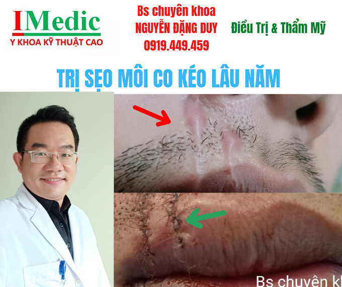 Sẹo lồi môi co kéo môi Cà Mau | Phẫu thuật thẩm mỹ Cà Mau | Mỹ Viện Nano Cà Mau | Phòng Khám Chuyên Khoa Kỹ Thuật Cao IMedic.vn | Bs chuyên khoa NGUYỄN ĐẶNG DUY 0919449459