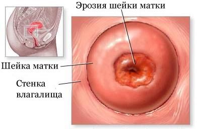 Ерозія шийки матки фотографії