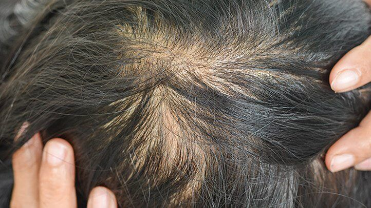 Hair Loss Caused By This Hormone