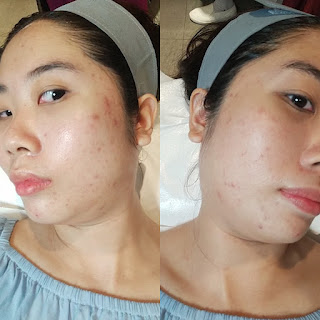 before-after-treatment-di-erha-clinic