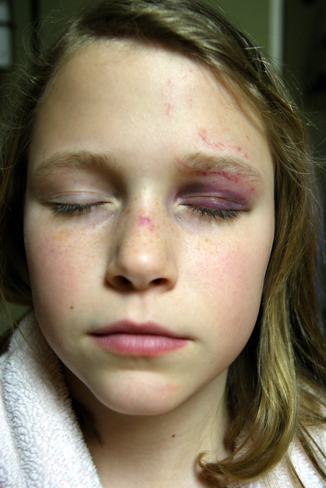 A Girl's 1st Black Eye