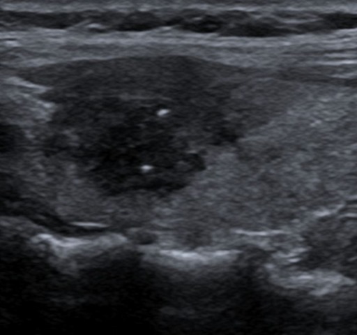 papillary_thyroid_carcinoma1-e1310622188728 papillary_thyroid_carcinoma1-e1310622188728