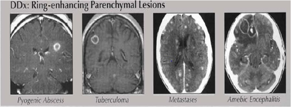 abnormal mri brain