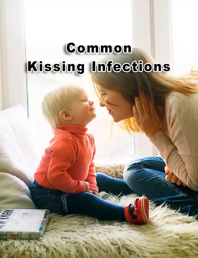 Herpetic pharyngitis and common Kissing infections