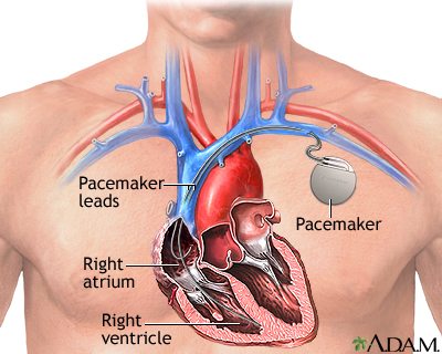 Pacemaker.jpg