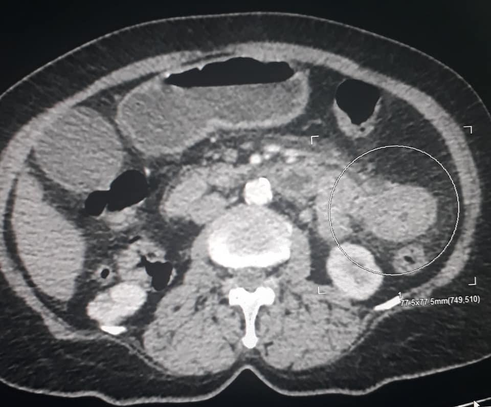 Scanner abdominale :hématome parietal